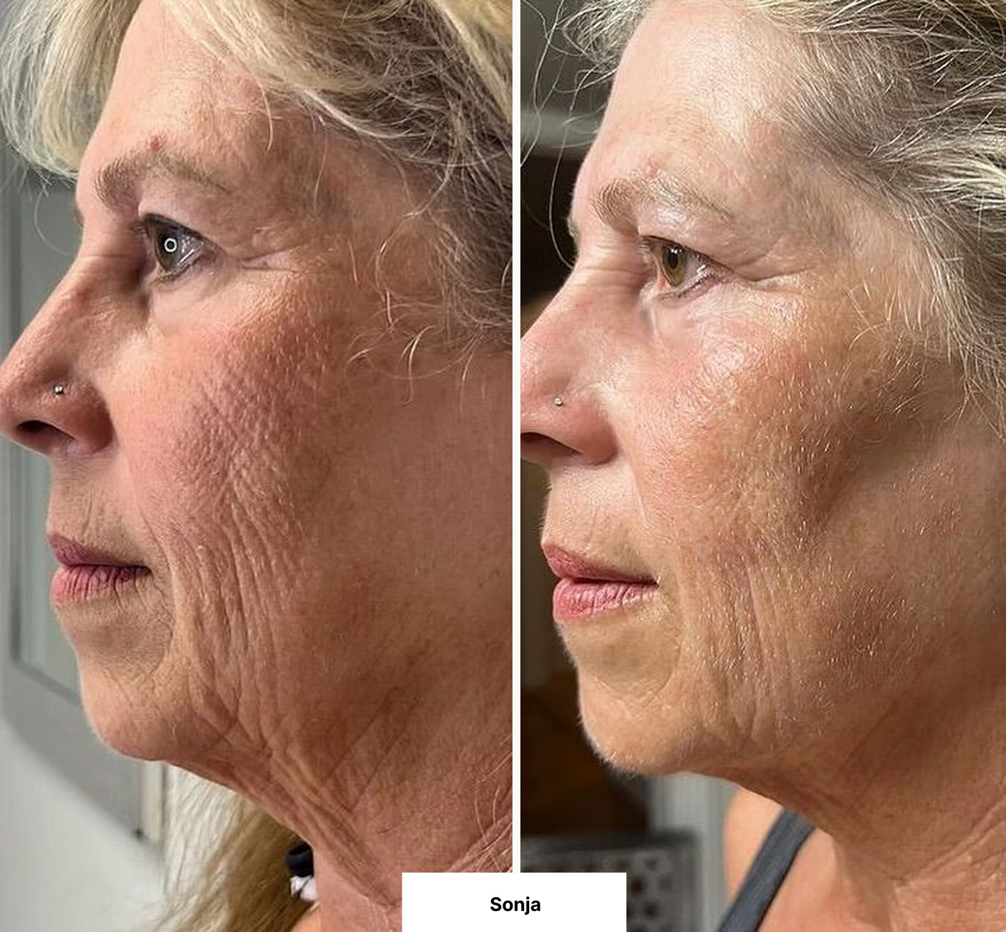 DERMASENSE™ – Herstel je huid van binnenuit