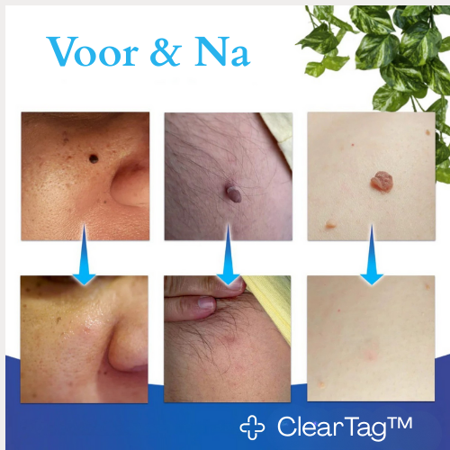 ClearTag™ – Terug naar een zelfverzekerde huid